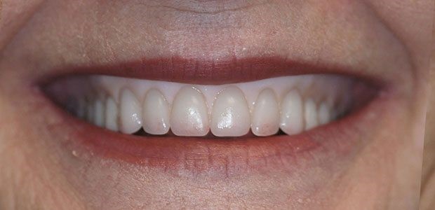 Permanent Dentures Cost Palo Pinto TX 76484